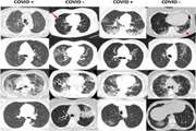 Deep COVID DeteCT: an international experience on COVID 19 lung detection and prognosis using chest CT