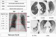 Predictors of The Chest CT Score in COVID 19 Patients: A Cross Sectional Study