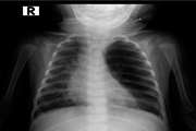 A Six month old Infant with Respiratory Distress and Cyanosis
