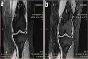 Clinical and laboratory findings following transplantation of allogeneic adipose derived mesenchymal stromal cells in knee osteoarthritis, a brief report