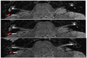 Correlation of semi quantitative findings of endolymphatic hydrops in MRI with the audiometric findings in patients with Meniere’s disease