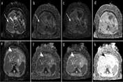 ] Prediction of hepatocellular carcinoma response to transarterial chemoembolization with intravoxel incoherent motion diffusion weighted imaging