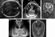 Fetal brain imaging: A comparison between fetal ultrasonography and intra uterine magnetic resonance imaging (a systematic review and meta analysis)