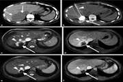Computed Tomography Fluoroscopy Guided Percutaneous Transhepatic Bleomycin/Ethiodized Oil Sclerotherapy for Symptomatic Giant Hepatic Hemangioma