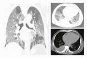 Chest CT scan features to predict COVID 19 patients’ outcome and survival