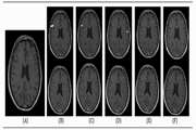 Comparison of Gadovist and Magnevist in Brain Magnetic Resonance Imaging of Multiple Sclerosis Patients with an Acute Attack