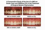 A Comparative Study of the Use of a 980 nm Diode Laser and 10600nm CO2 in the Treatment of Gingival Melanin Pigmentation